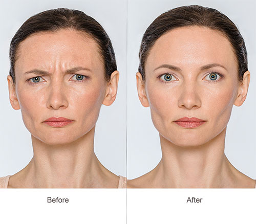 Botox Cosmetic® Before & After